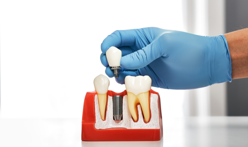Dental Implants: Crafting a Natural-Looking Smile