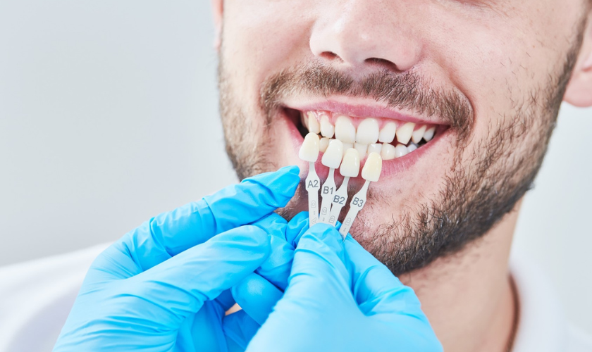 Understanding Dental Veneers and Their Benefits (1)