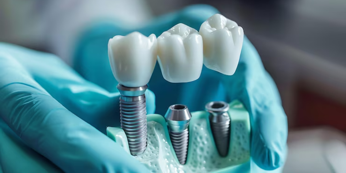 care for your dental implants for longevity