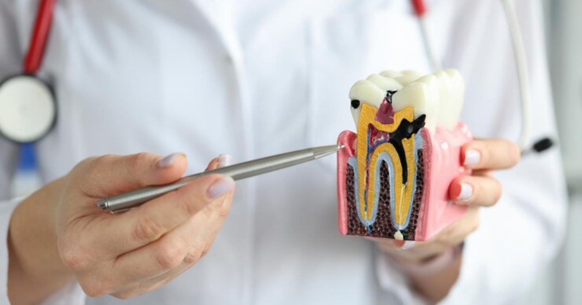 signs you may need a root canal