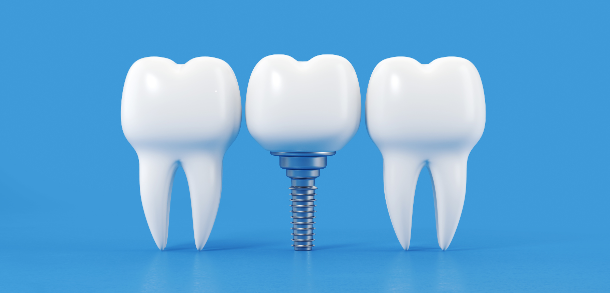 Can You Get Dental Implants If You Have Gum Disease