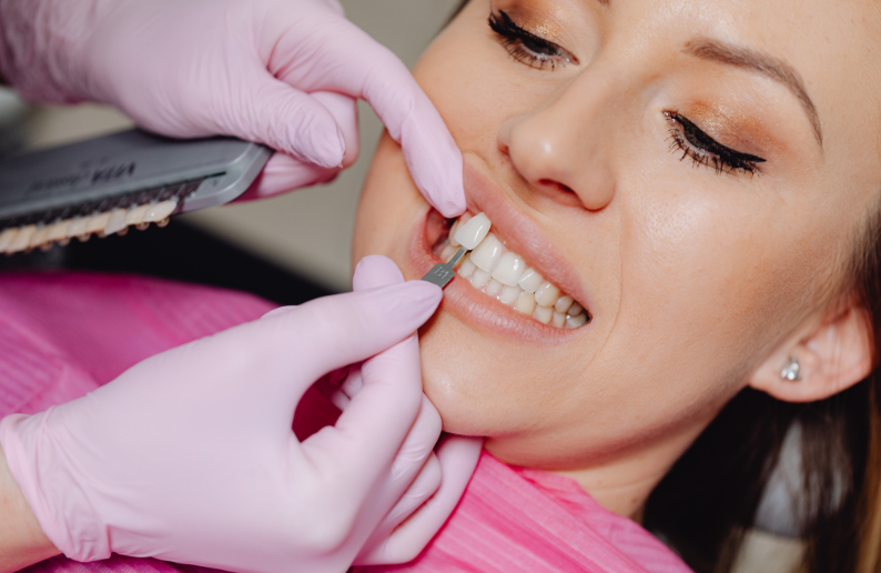 How Long Do Dental Veneers Last? Maintenance and Longevity