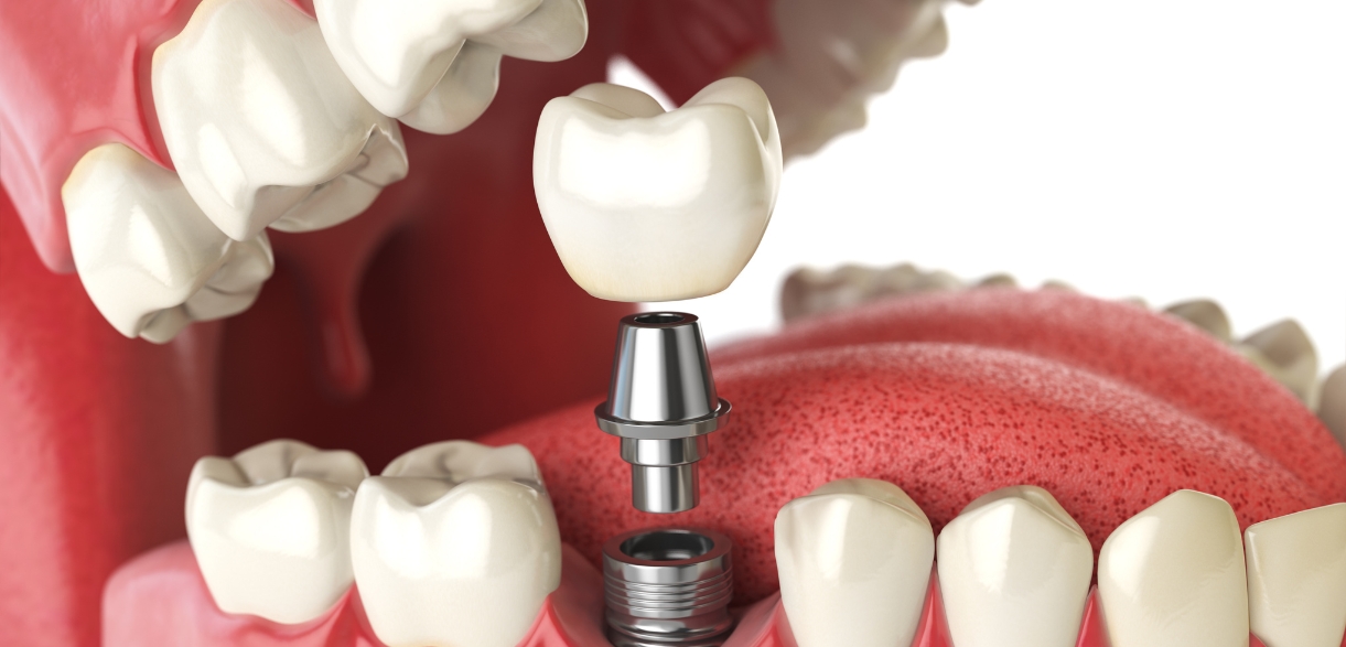 Are Dental Implants The Best Tooth Replacement Option?