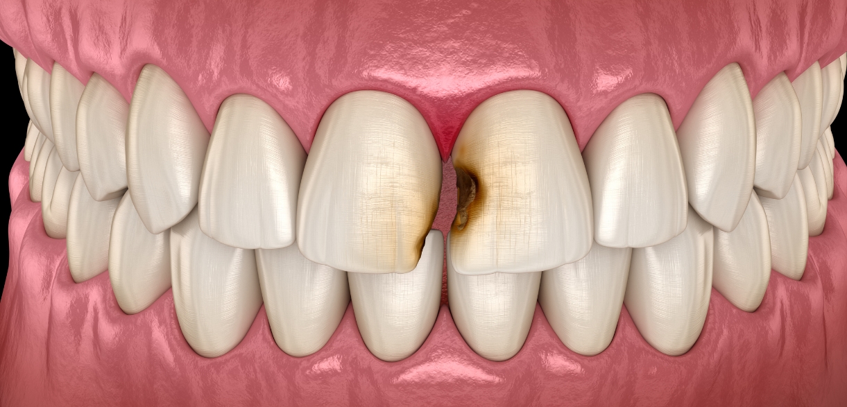 Tooth Abscess Emergency: Symptoms, Risks & When to Seek Help